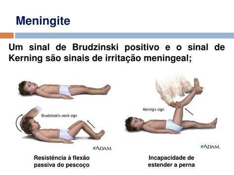 meningite sinal de kernig e brudzinski